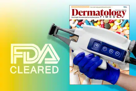 FDA Clears Accure Laser System for Acne Treatment